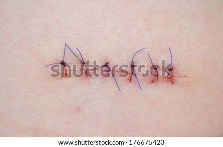 stock images similar to id 108133865 stitches on arm after stock images royalty free images vectors stock images similar to id 108133865 stitches on arm after stock images royalty free images vectors