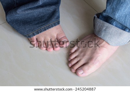 men flat feet