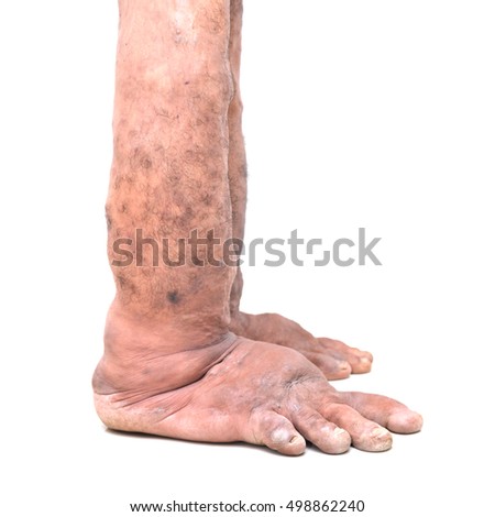 toenail Fungus Symptoms Toe Nail Infection" Stock Photos, Royalty ...