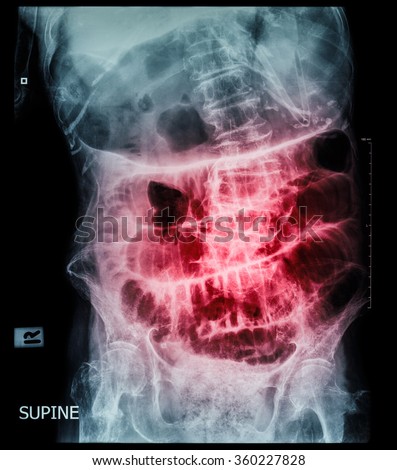 intestinal blockage timeline step scan stock photos images pictures intestinal blockage timeline step scan stock photos images pictures