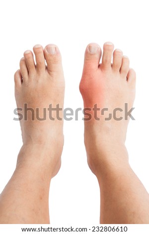 Tight deformed From shoes   feet Asian Feet Wearing Of Woman Elderly Deformed  Shoes for An
