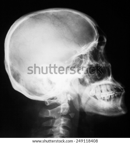accident adult cerebrovascular in young accident adult cerebrovascular in young