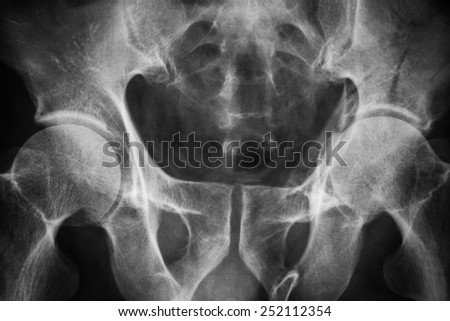 Film x-ray normal pelvis - stock photo