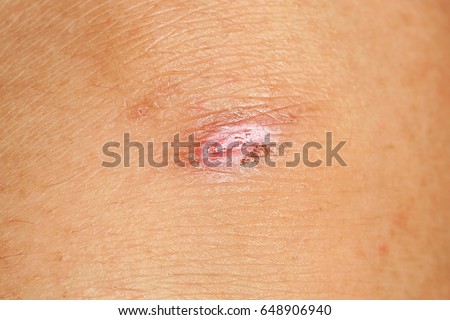 burn scar stock photo 57476164 burn scar stock photo 57476164 burn scar stock photo 57476164 burn scar stock photo 57476164