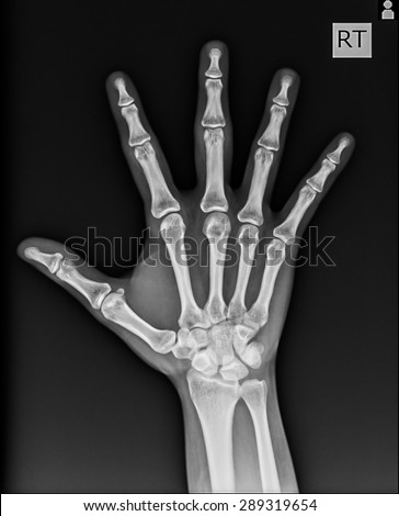 Human Left Hand Xray Medical Image Stock Photo 110237552 - Shutterstock