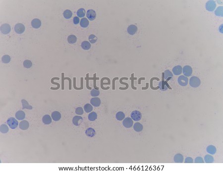 Levetiracetam-induced pancytopenia