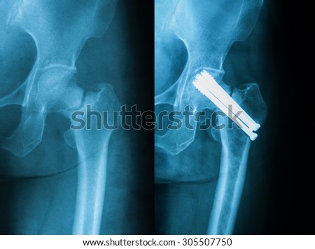 broken hip prothesis broken hip prothesis