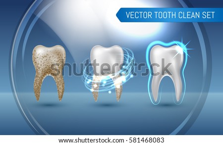 Vector set of 3d realistic clean and dirty tooth on blue background, clearing tooth process. Teeth Whitening. Dental health Concept. Oral Care, teeth restoration Vector set of 3d realistic clean and dirty tooth on blue background, clearing tooth process. Teeth Whitening. Dental health Concept. Oral Care, teeth restoration