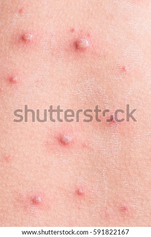 Chickenpox Stock Images, Royalty-Free Images & Vectors ...