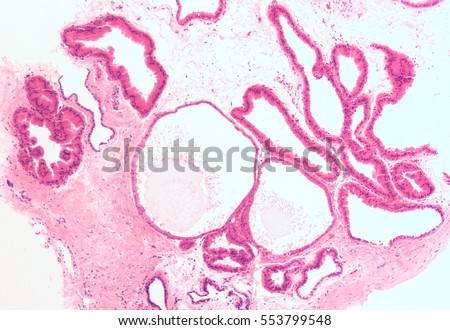 breast calcium deposits wife full of cum photos
