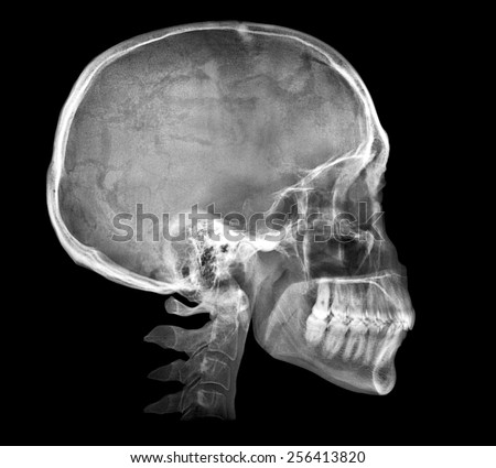 Film Xray Skull Lateral Show Normal Stock Photo 221345149 - Shutterstock