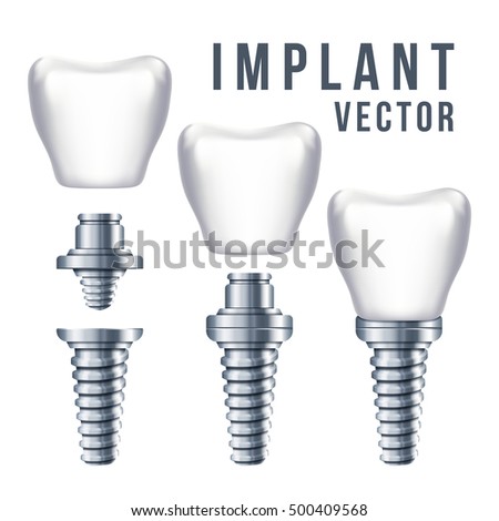 Dental tooth implant and parts vector illustration. Implantation dentistry and care to teeth Dental tooth implant and parts vector illustration. Implantation dentistry and care to teeth
