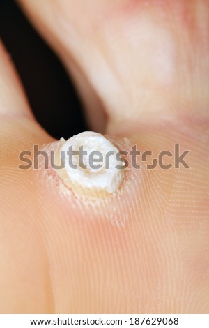 wart falling feet plantar benign sole papilloma shutterstock viral etiology growths skin female