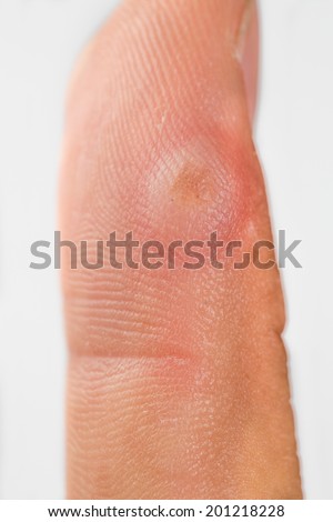 verruca blister closeup freezing finger treatment warts shutterstock illustrations