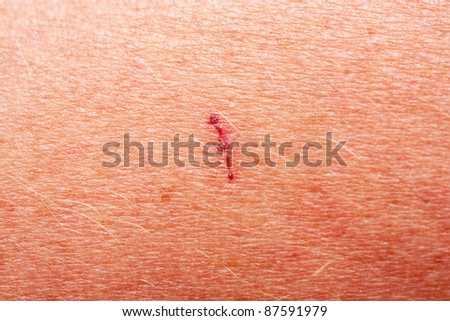 Cut Skin Stock Photos, Images, & Pictures | Shutterstock