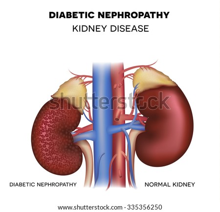 Aluminum Induced Nephropathy Diet