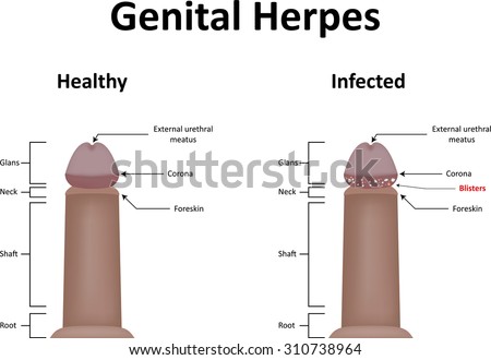 Herpes In Men First Outbreak - Doctor answers on HealthTap