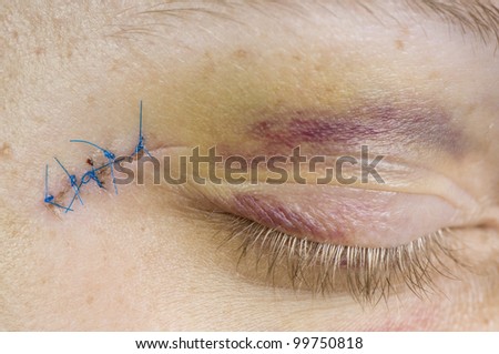 stock images similar to id 108133865 stitches on arm after stock images similar to id 108133865 stitches on arm after stock images similar to id 108133865 stitches on arm after stock images similar to id 108133865 stitches on arm after