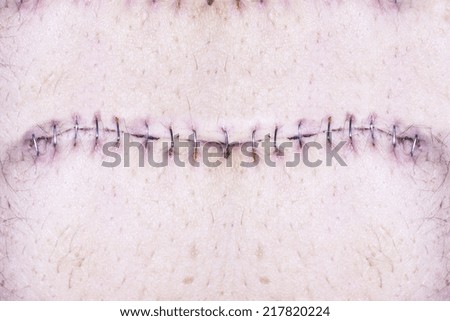 stock images similar to id 108133865 stitches on arm after stock images similar to id 108133865 stitches on arm after stock images similar to id 108133865 stitches on arm after stock images similar to id 108133865 stitches on arm after