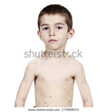 pussy fucking clip video chicken pox on teen boys
