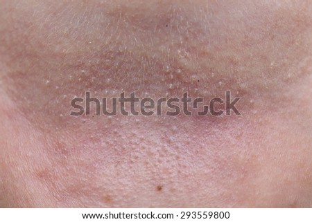 What Does Prickly Rash Look Like Baby