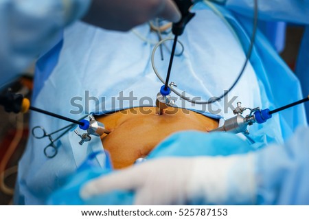 Laparoscopy Stock Images, Royalty-Free Images & Vectors | Shutterstock