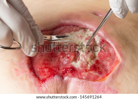 Skin Ulcers Stock Images, Royalty-Free Images & Vectors ... human body diagram pressure ulcer 