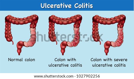 Diagram Showing Ulcerative Colitis Illustration Stock ... diagram of colitis 