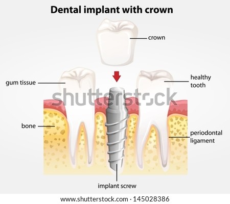 Ilustração mostrando o implante dentário com coroa