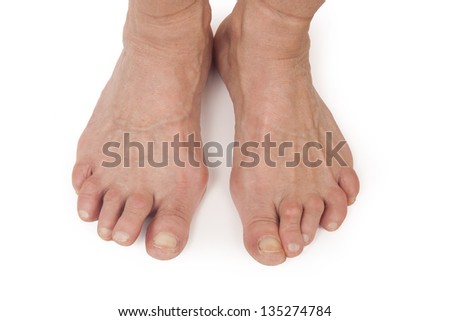 Deformed Male Feet Stock Photo 136825895 - Shutterstock