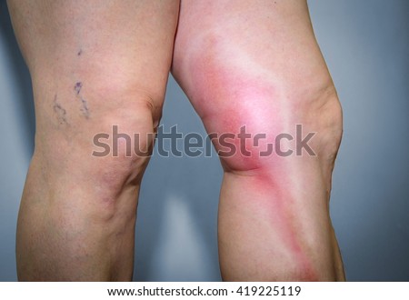 Thrombophlebitis in human leg. Painful inflammation of the leg veins. Medical issue