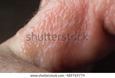 up macro poison rash blisters on human skin stock photo royalty free image 124345749 stock photos royalty free images vectors up macro poison rash blisters on human skin stock photo royalty free image 124345749 stock photos royalty free images vectors