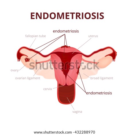 endometriosis schematic illustration uterus female reproductive reproductive system diseases