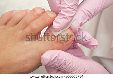 Điều trị bàn chân Doctor Loại bỏ vết chai, ngô và xử lý móng mọc ngược. Phần cứng móng. Khái niệm chăm sóc cơ thể.