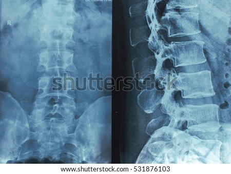 x-rays of the spine