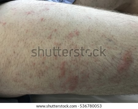 Erythema Stock Images, Royalty-Free Images & Vectors | Shutterstock