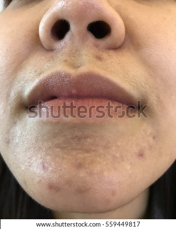Redhead mega facial Bikini waxing highlands ranch co