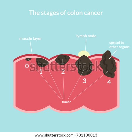 Stages Of Colon Cancer Chart