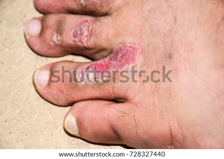 Pityriasis Rosea Stock Images, Royalty-Free Images & Vectors | Shutterstock