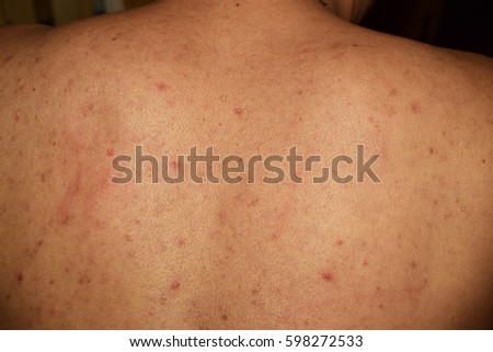 Acne on the human skin , take care your skin with cream or lotion.
