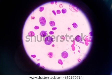 Abnormal Malignant Cells Specimen Pleural Fluid Stock Photo 684549496