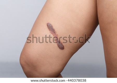 skin scar stock images royalty free images vectors keloid scar stock images royalty free images vectors skin scar stock images royalty free images vectors keloid scar stock images royalty free images vectors