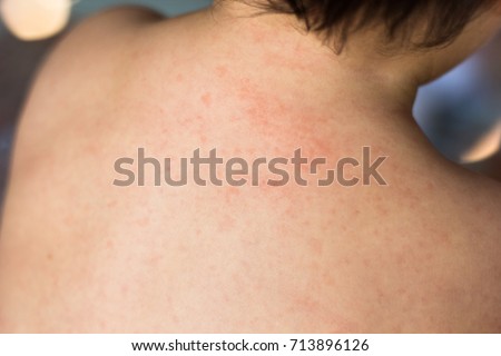 Little Baby Body Cover Roseola Infantum Stock Photo (Royalty Free ...
