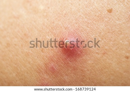 pictures of pimple on human skin macro csp9188528 search stock photos images carbuncle stock images royalty free images vectors pictures of pimple on human skin macro csp9188528 search stock photos images carbuncle stock images royalty free images vectors