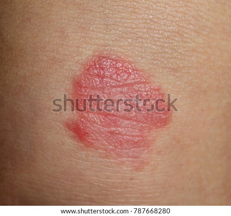 Psoriasis Plaque A Case Psoriasis Vulgaris Stock Photo (Royalty Free ...