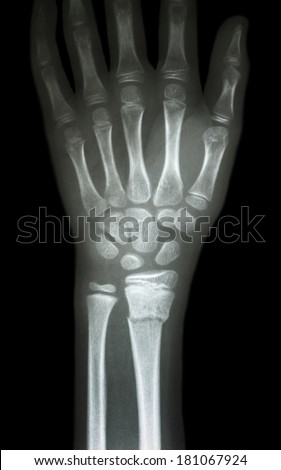 Xray Human Hand Wrist Stock Photo 62282380 - Shutterstock