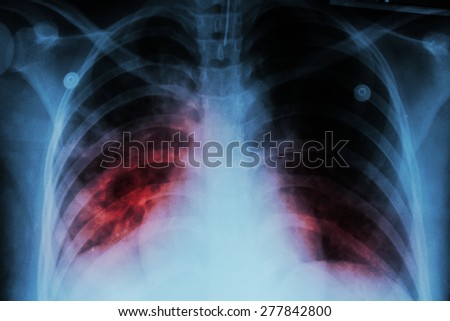 How is a lung infection treated?