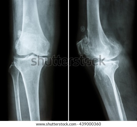 Collection Xray Normal Knee Stock Photo 73834516 - Shutterstock