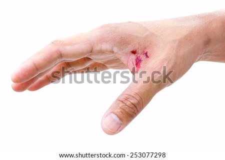 Open Wound Stock Images, Royalty-Free Images & Vectors | Shutterstock