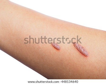 Scalds Stock Photos, Images, & Pictures | Shutterstock